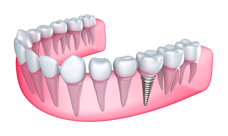 implant-tedavisi-1